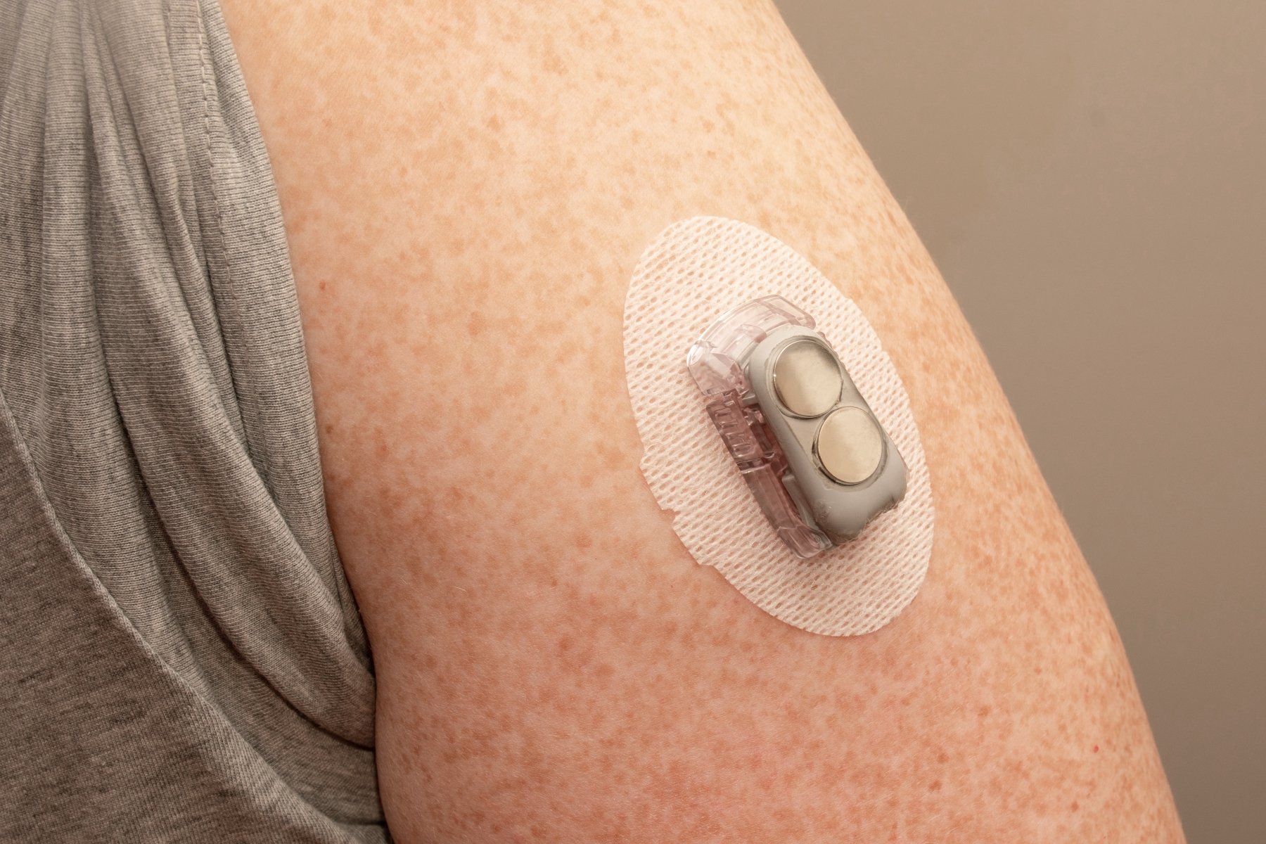 Example of Dymax 2022-MW medical wearables adhesive used for continuous glucose monitoring